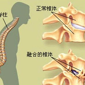 强直性脊椎炎